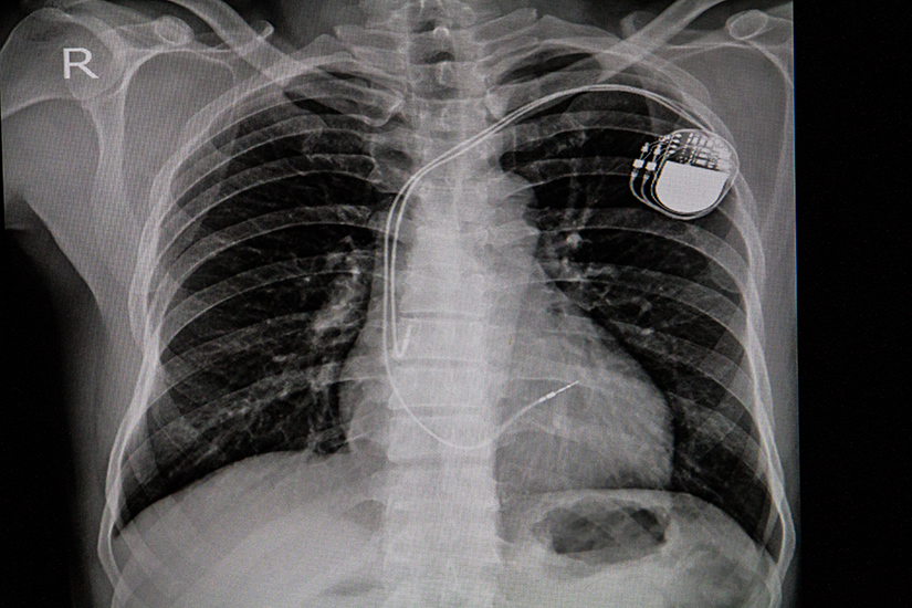 CardiacPICUスタンダード　裁断済み Implantare stimulator cardiac permanent | Reginamaria.ro